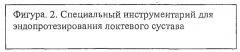 Способ лечения тяжелых внутрисуставных переломов локтевого сустава (патент 2463980)