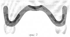 Способ получения дифференцированного функционального оттиска при полном съемном протезировании (патент 2271771)