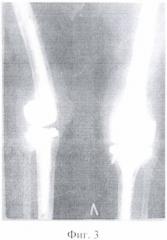 Способ замещения обширных дефектов мыщелков бедренной и большеберцовой костей при ревизионном эндопротезировании коленного сустава (патент 2355324)
