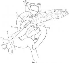 Способ хирургического лечения наружных панкреатических свищей (патент 2447839)