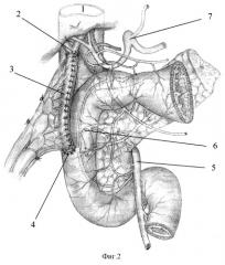Способ пластики гепатикохоледоха трубчатым тонкокишечным трансплантатом (патент 2249434)