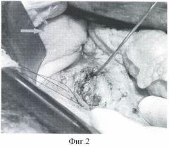 Способ резекции поджелудочной железы при хроническом панкреатите (патент 2465842)