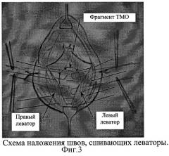 Способ хирургического лечения ректоцеле (патент 2283038)