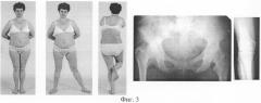 Способ репозиционирования биомеханической оси конечности при эллипсовидной деформации головки бедренной кости (патент 2326616)