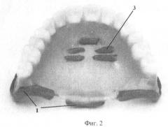 Способ изготовления полных съемных зубных протезов (патент 2448665)