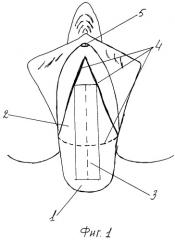 Трансобтураторный способ с применением собственного лоскута из стенки влагалища и слизистой шейки матки при стрессовом недержании мочи в сочетании с пролапсом гениталий (патент 2338474)