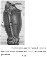 Способ лечения юношеского эпифизиолиза головки бедренной кости у детей (патент 2422110)