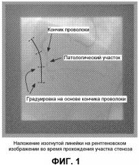 Помощь в подборе размера устройств в процессе оперативных вмешательств (патент 2556535)