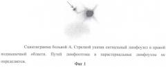 Способ индивидуальной предлучевой подготовки больных раком молочной железы (патент 2377020)