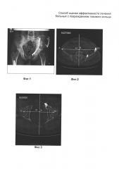 Способ оценки эффективности лечения больных с повреждением тазового кольца (патент 2600221)