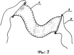 Устройство для репозиции отломков большеберцовой кости (патент 2266074)