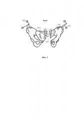 Способ использования оптической медицинской навигационной системы для визуализации и количественной оценки качества репозиции отломков при переломе кости таза (патент 2635451)