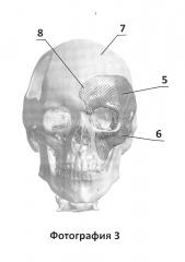 Имплантат для протезирования костей черепа и способ изготовления имплантата для протезирования костей черепа (патент 2638894)