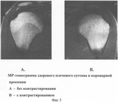 Способ диагностики нестабильности плечевого сустава (патент 2277852)