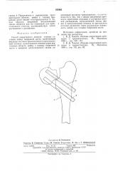 Способ оперативного лечения ложных суставов шейки бедренной кости (патент 552963)