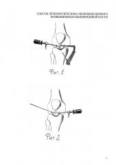 Способ лечения перелома межмыщелкового возвышения большеберцовой кости (патент 2640945)