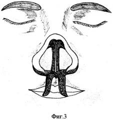 Способ пластики перегородки носа (патент 2302212)