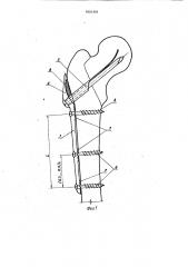 Фиксатор для остеосинтеза вертельных переломов бедра (патент 1801401)