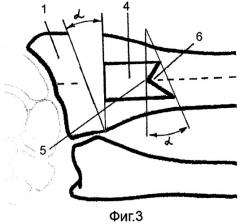Способ устранения угловой деформации суставного отдела кости (патент 2325862)