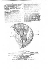 Способ лечения последствий травм органа зрения с рубцовыми изменениями (патент 1126298)