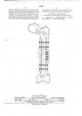 Устройство для фиксации костных фрагментов (патент 718097)