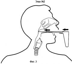 Устройство для получения трахеобронхиального содержимого при патологии бронхолегочной системы (патент 2363505)