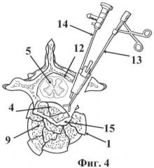 Способ декомпрессии спинного мозга при переломах грудных и поясничных позвонков (патент 2467716)