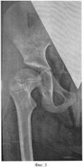 Способ выполнения двойной остеотомии бедренной кости (патент 2531444)