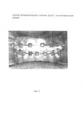 Способ ортодонтического лечения детей с ретенированными зубами (патент 2629061)