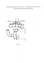 Способ хирургического лечения вторичного стеноза пищеводного анастомоза после резекции проксимального отдела желудка (патент 2657192)