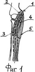 Способ устранения пронационной контрактуры предплечья в сочетании со сгибательной контрактурой лучезапястного сустава и пальцев у больных спастическим параличом (патент 2343864)