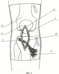 Способ хирургического лечения застарелого разрыва связки надколенника (патент 2471446)