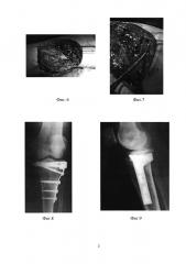 Способ остеоартропластики импрессионного полифокального перелома периферической части плато большеберцовой кости (патент 2647618)