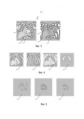 Эффективные последовательности выполняемых действий магнитно-резонансной визуализации сердца на основании автоматизированного планирования по обзорным исследованиям по технологии mdixon (патент 2632246)