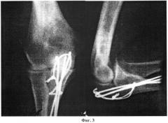 Способ остеосинтеза переломов локтевого отростка (патент 2409327)