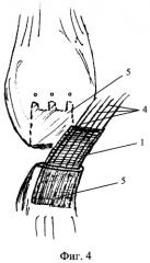 Способ пластики поврежденных связок и сухожилий (патент 2303411)