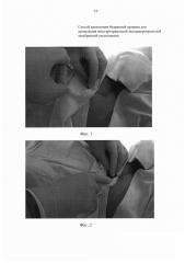 Способ канюляции бедренной артерии для проведения вено-артериальной экстракорпоральной мембранной оксигенации (патент 2632514)