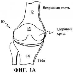 Способы, инструменты и материалы для трансплантации зрелых клеток хрящевой ткани (патент 2244521)