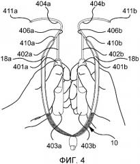 Вспомогательное центрирующее устройство для имплантируемой петли (патент 2540167)
