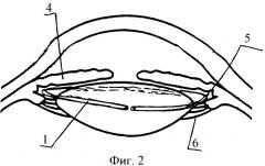 Имплантат для хирургического лечения пресбиопии и способ его имплантации (патент 2329019)