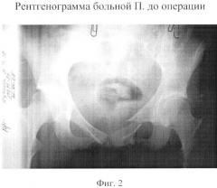 Способ лечения повреждений таза с нарушением целостности переднего и заднего его отделов (патент 2364359)