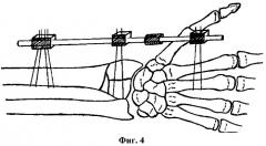 Способ лечения застарелых переломов дистального отдела костей предплечья и устройство для его осуществления (патент 2266073)