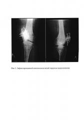 Способ остеосинтеза при многофрагментарных оскольчатых переломах надколенника (патент 2615665)