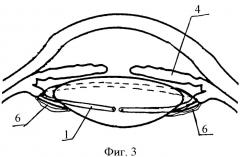 Имплантат для хирургического лечения пресбиопии и способ его имплантации (патент 2329019)