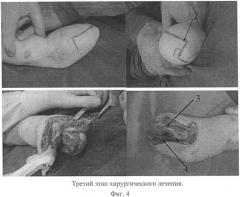 Способ создания функциональности короткой культи предплечья (патент 2392893)