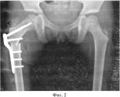 Способ хирургического лечения деформаций проксимального отдела бедра у детей (патент 2570046)
