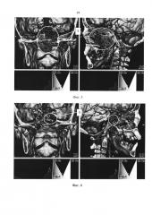 Способ визуализации результата хирургического лечения ювенильных ангиофибром носоглотки и основания черепа (патент 2649474)