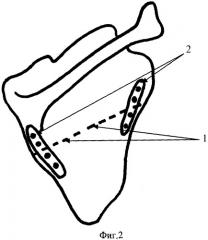 Способ лечения крыловидной лопатки при сколиозе позвоночника (патент 2338476)