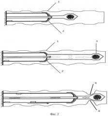 Устройство для интубации тонкой кишки в технически сложных условиях (патент 2536787)