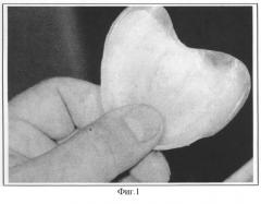 Способ установления оптимальных границ базисов полных съемных протезов верхней и нижней челюстей при неблагоприятных клинических условиях протезного ложа (патент 2274429)